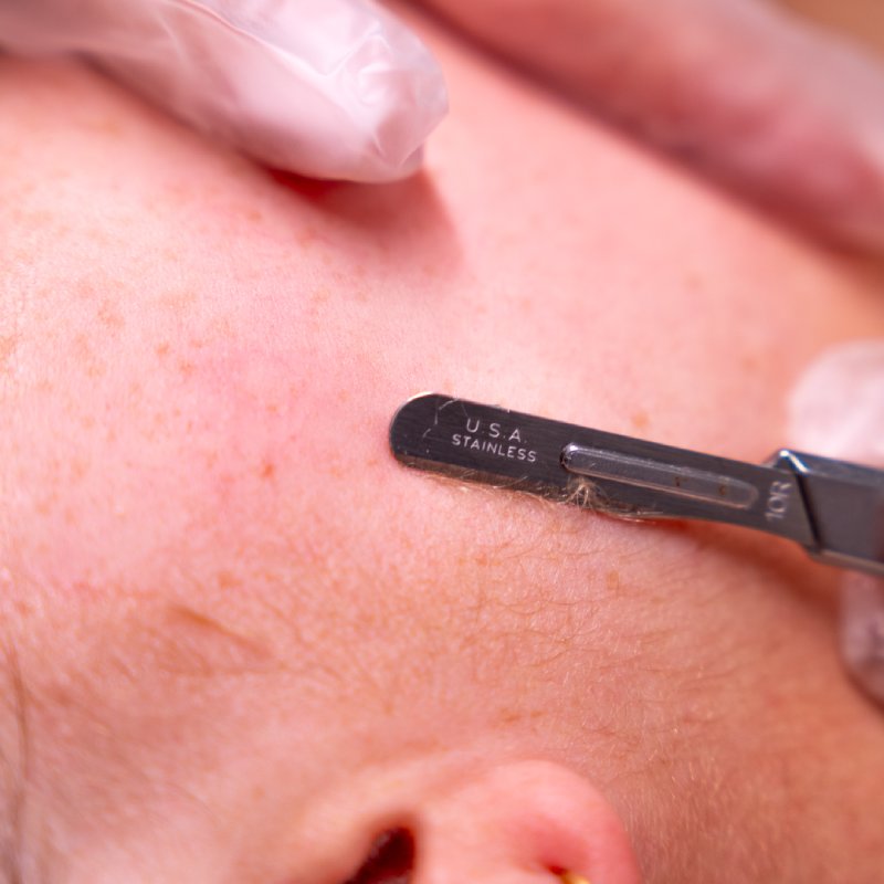 dermaplaning-treatment
