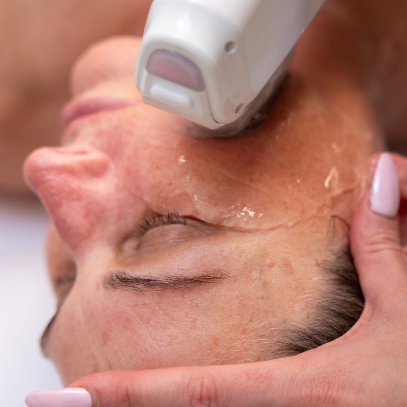 hifu-treatment