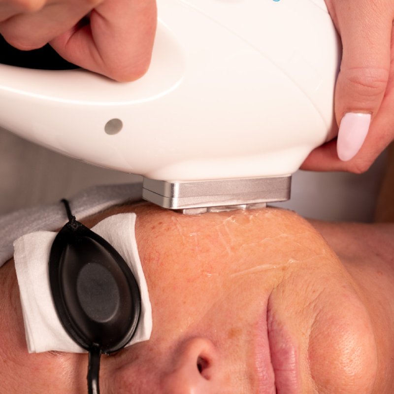 ipl-skin-rejuvenation-treatment