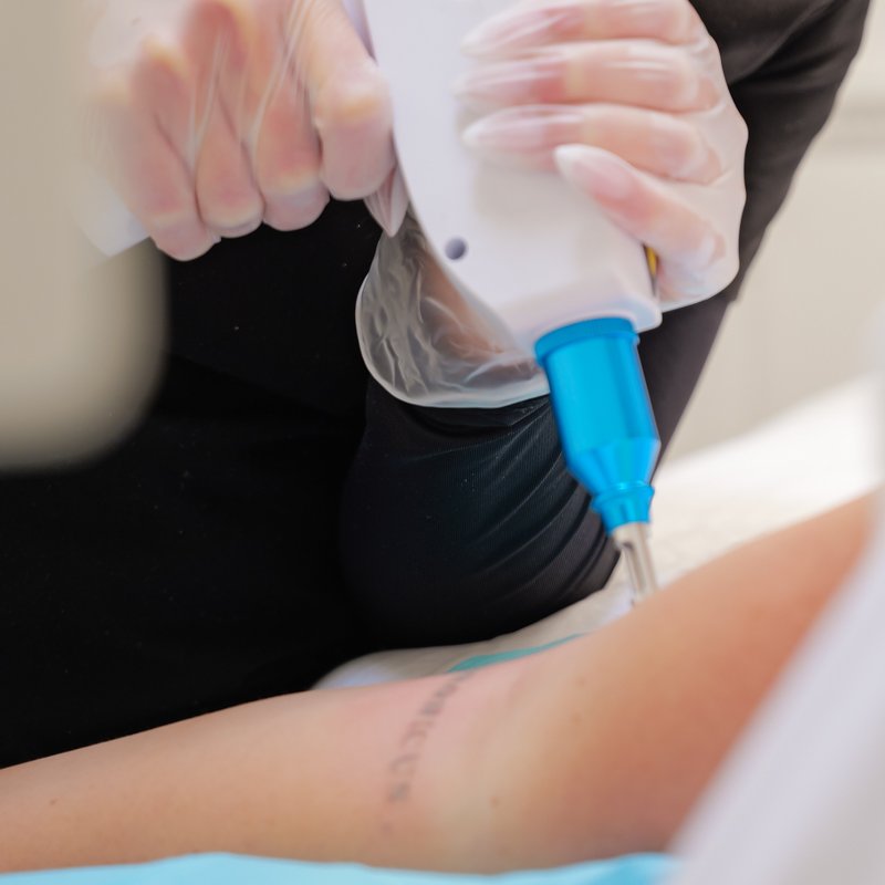 laser-tattoo-removal