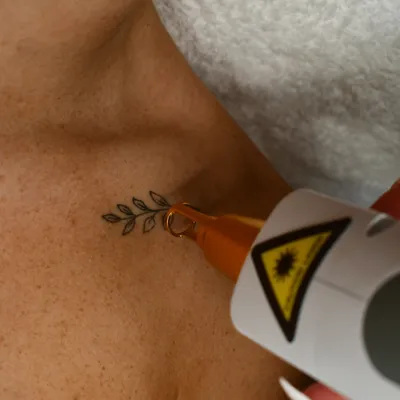 laser-tattoo-removal