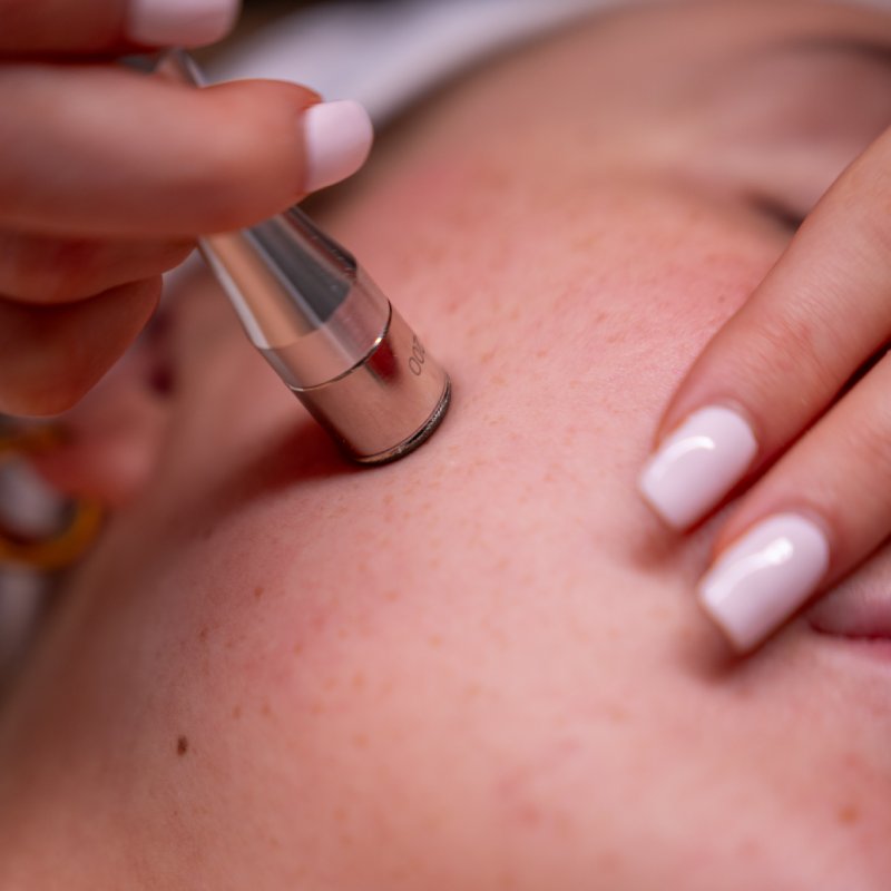microdermabrasion-treatment