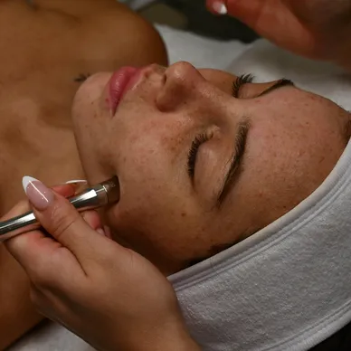 microdermabrasion